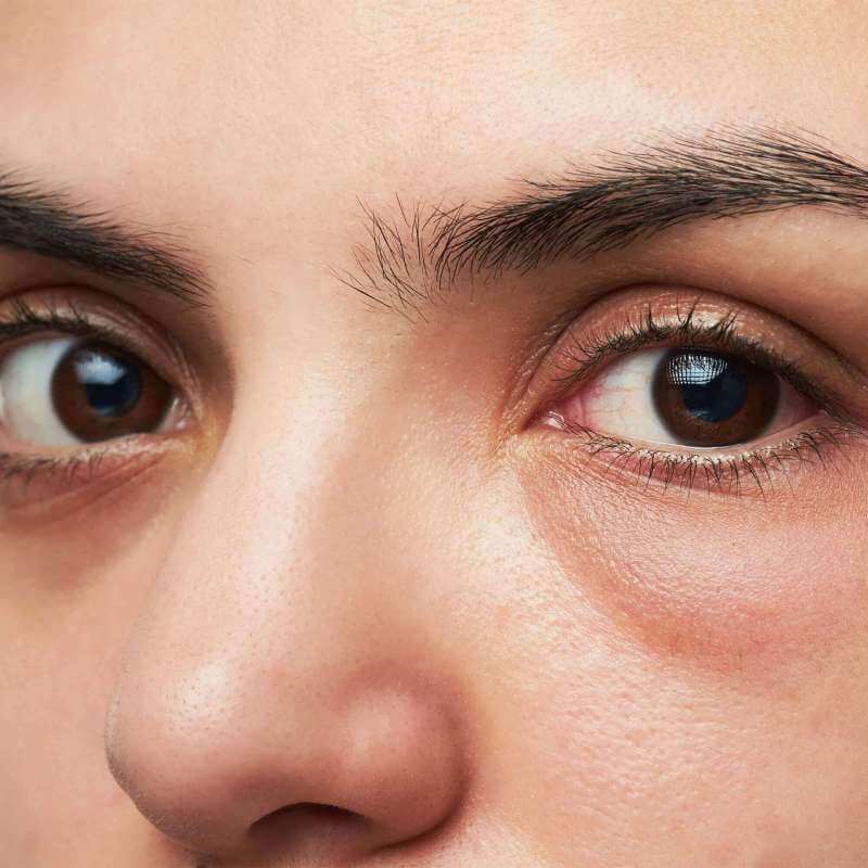 Under Eye Dark Circles and Puffiness - the causes and - Reviva Labs