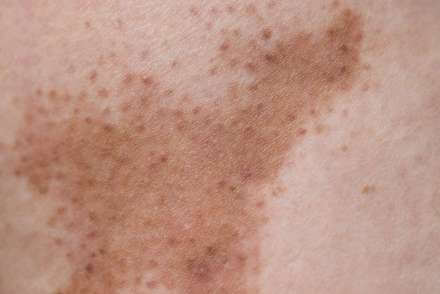 Melasma or skin darkening example