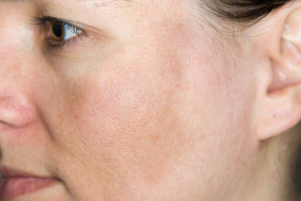 Uneven skin tone due to melasma