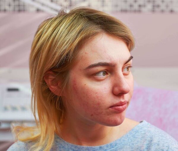 young blonde female with acne