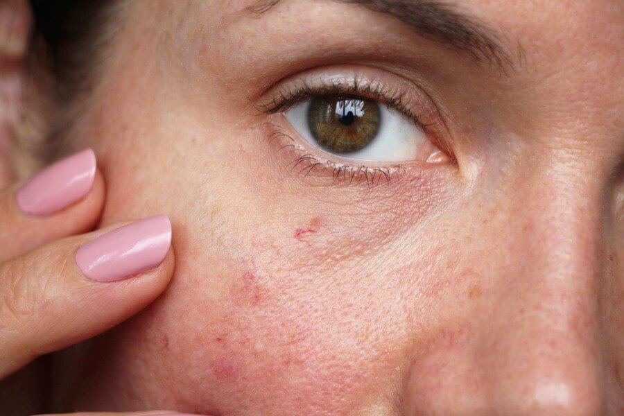 example of female examining sensitive skin around her eye area