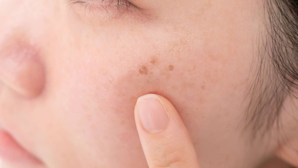 female pointing at darks spots and hyperpigmentaion on her cheek