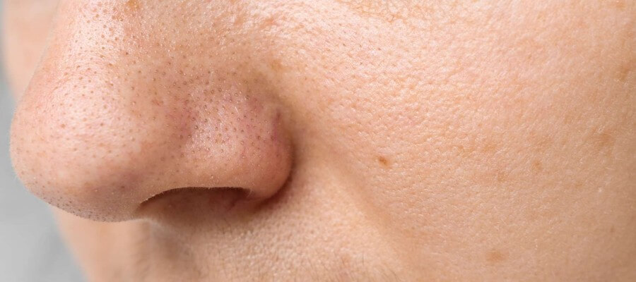 acne pimples on the nose close up 2022 04 22 13 05 52 utc