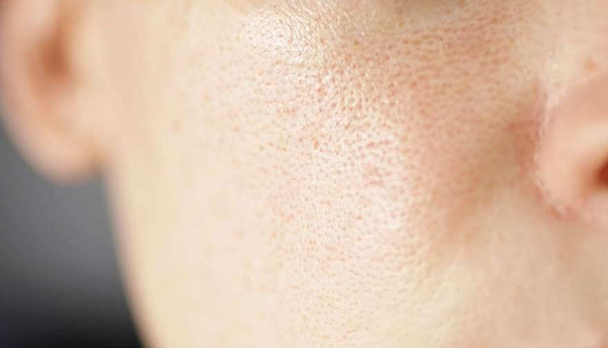 skin texture unhealthy with with enlarged pores a 2022 10 31 05 59 48 utc