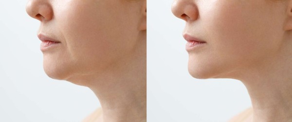 facial jowls before and after as484218321