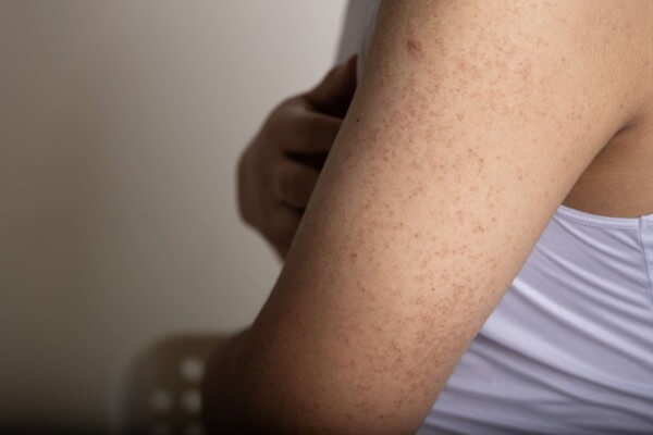 keratosis pilaris as538370622