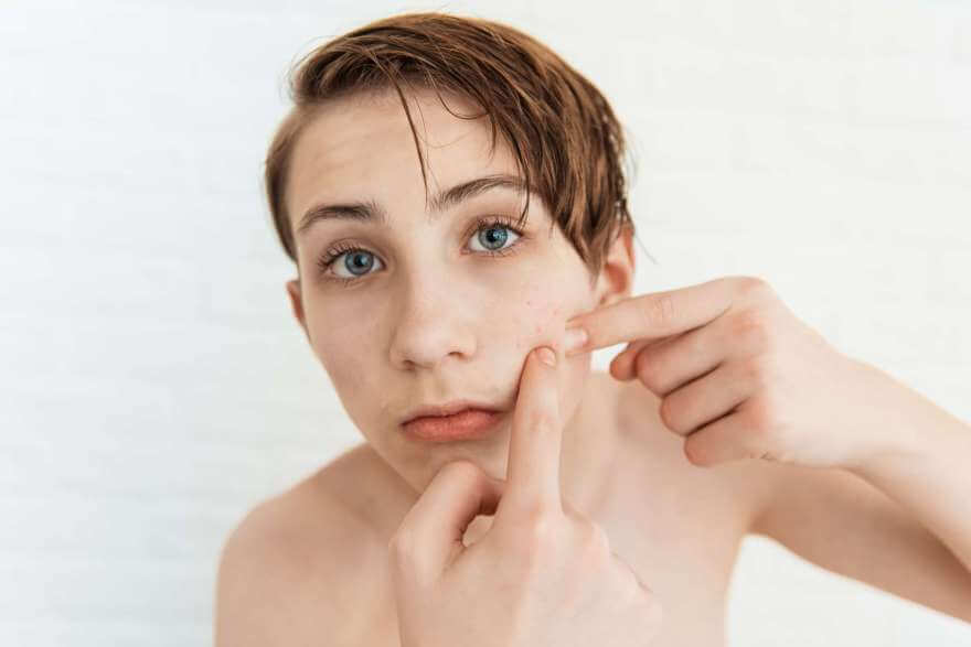 teen boy with red pimples on on his face closeup 2022 10 31 21 20 16 utc