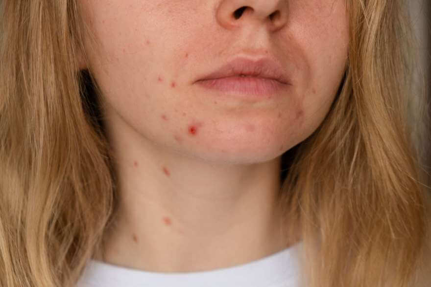 unrecognizable woman showing her acne on face clo 2022 10 18 00 53 46 utc