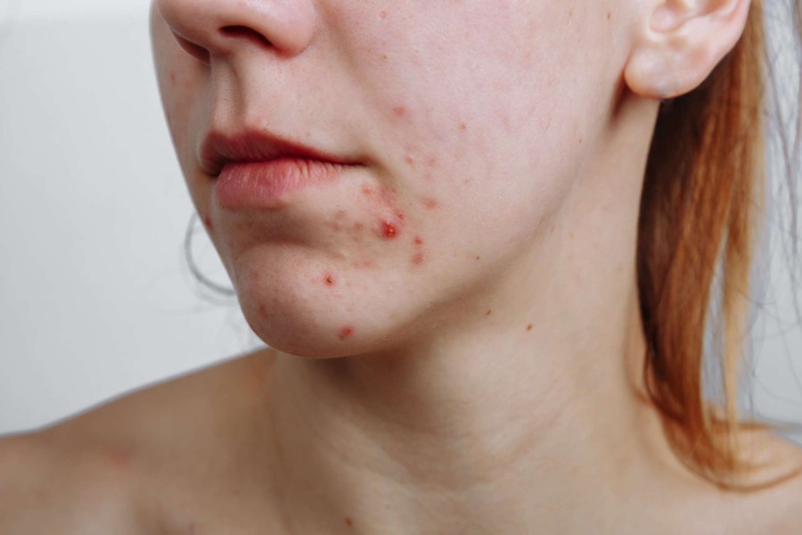 A Woman Was Misdiagnosed With Acne When She Really Had Folliculitis