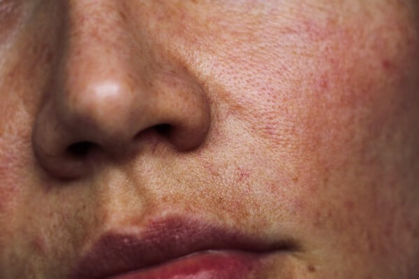 pigmentation on the face. red spots