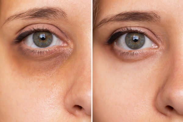 cropped shot of a young caucasian woman's face with dark circles under eyes before and after cosmetic treatment. bruises under the eyes caused by fatigue, insomnia, stress. the result of therapy