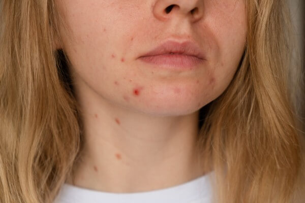 unrecognizable woman showing her acne on face. close up acne on woman's face with rash skin ,scar and spot that allergic to cosmetics. problem skincare and health concept. wrinkles, melasma, dark spots, freckles, dry skin, acne blackheads on face middle age women chin acne problem skin