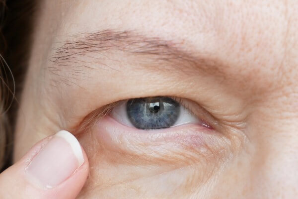 middle aged woman does corrective eye makeup to correct the drooping eyelid. ptosis is a drooping of the upper eyelid, lazy eye. cosmetology and facial concept