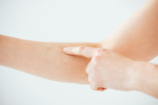 cropped view of woman pointing with finger at melanoma on white