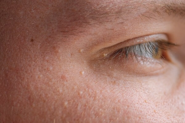 milia (milium) pimples around eye on skin. eyes of young man with small papillomas on eyelids or growths on skin