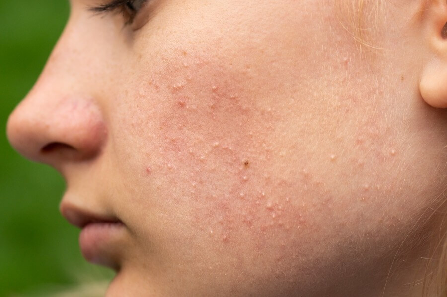 problematic skin. acne and red festering pimples on the face of a young girl. facials for teen girls.