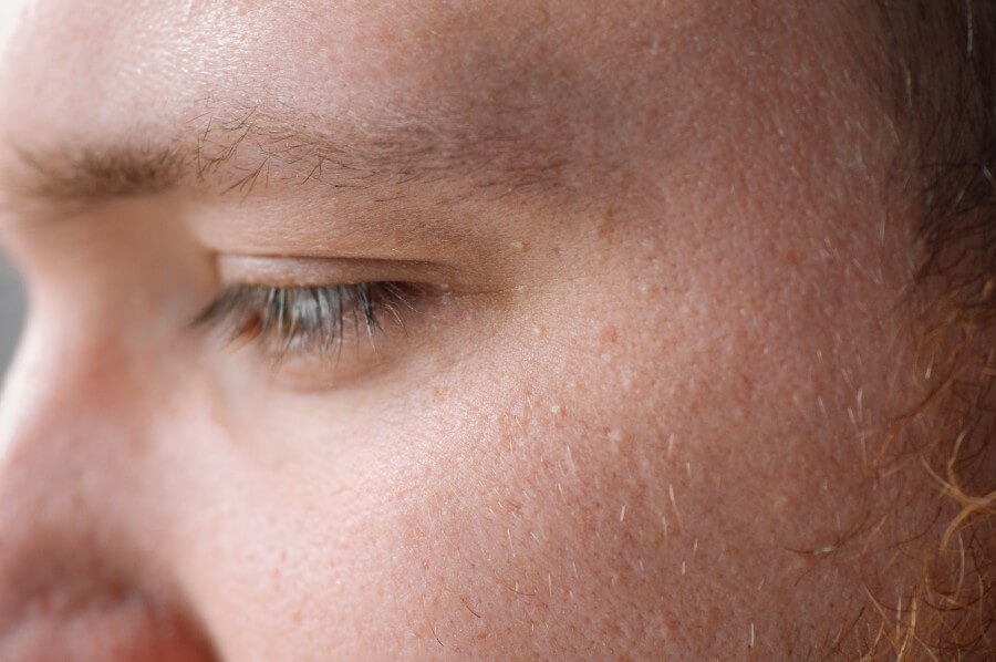 milia (milium) pimples around eye on skin. eyes of young man with small papillomas on eyelids or growths on skin