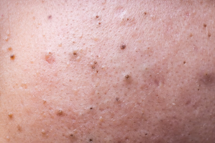 ugly pimples blackheads on face of teenager