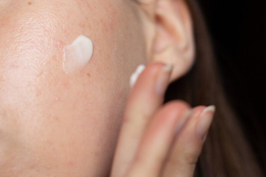 closeup of a young woman applying prescription azelaic acid to her acne prone skin with scarring and post inflammatory erythema.