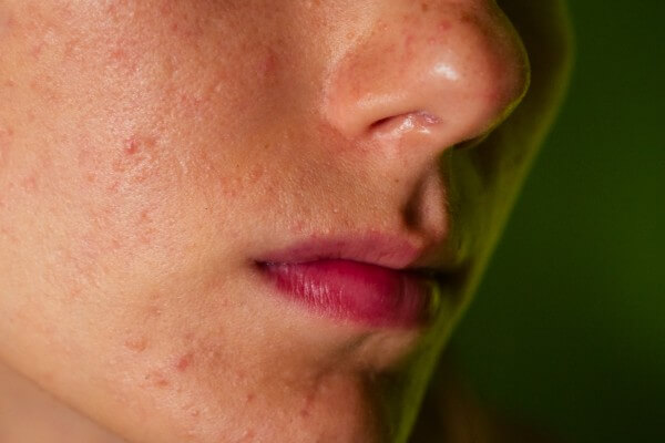 post acne, scars and red festering pimples on the face of a young woman. concept of skin problems and harmonic failure