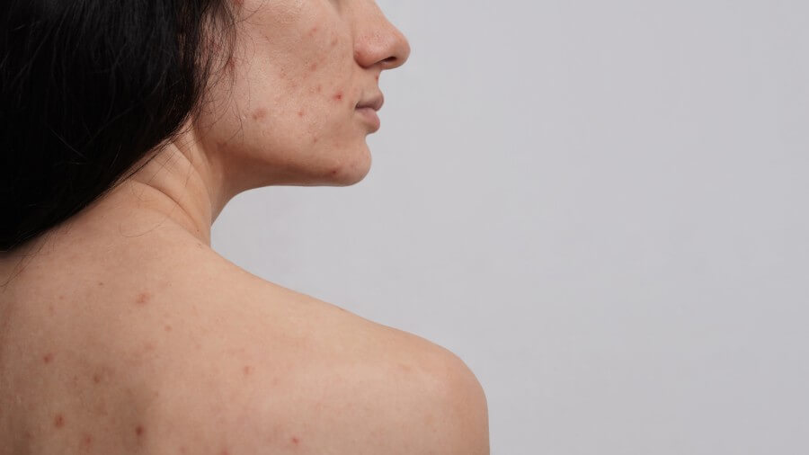 a close up of a panoramic image of the skin of a woman with acne and other dermatological problems. a place for your text.