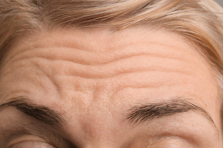 female forehead with wrinkles