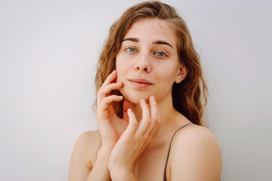 close up portrait of a beautiful woman without makeup with imperfect skin. acne skin. natural beauty