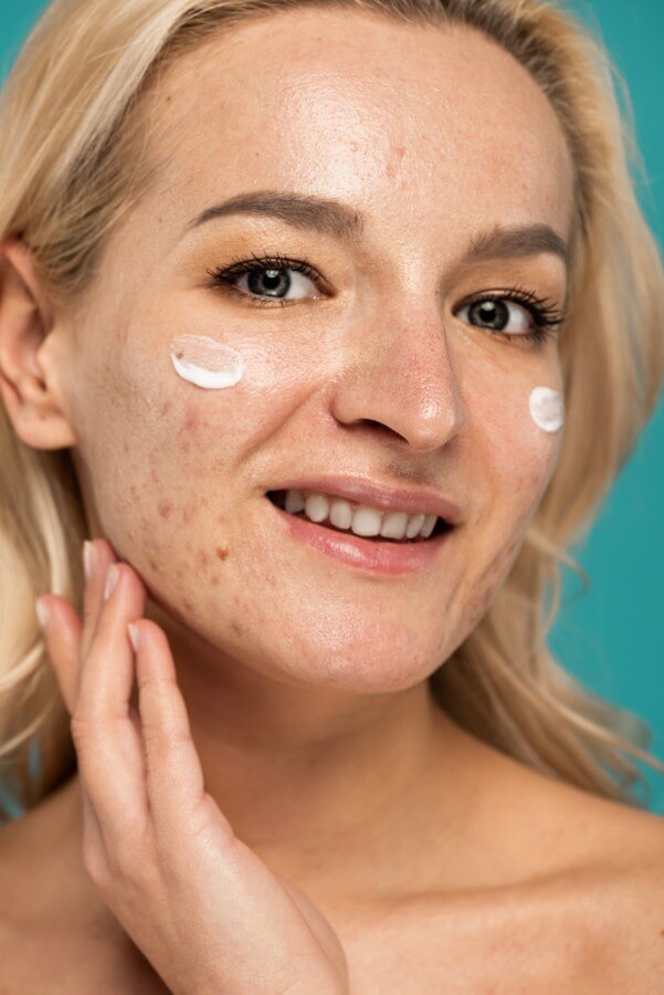 close up of cheerful woman with skin issues applying treatment cream on face isolated on turquoise