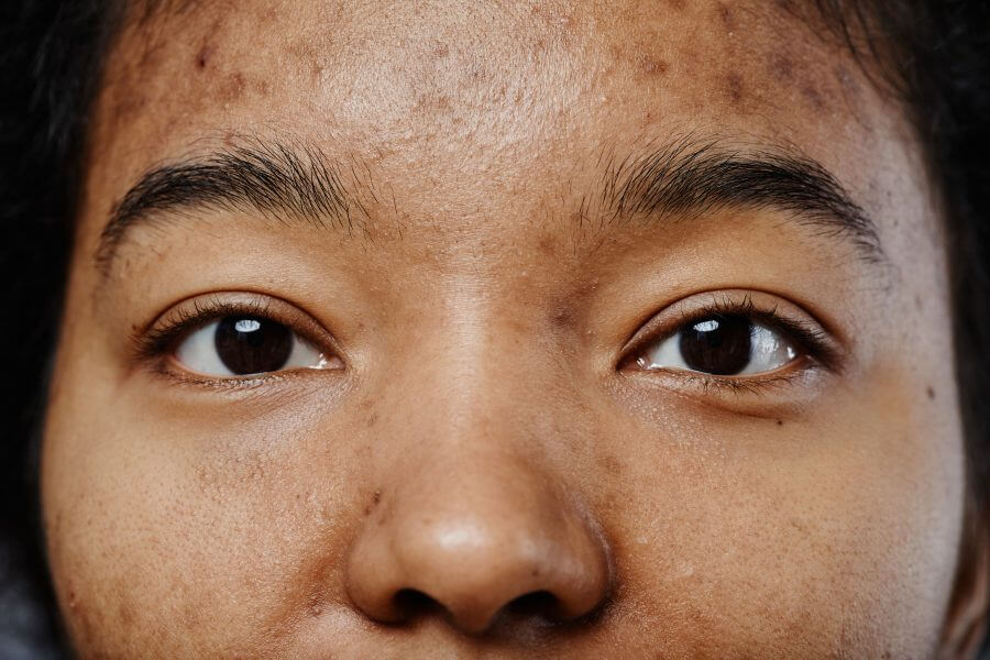 closeup of black young woman with acne scars on face