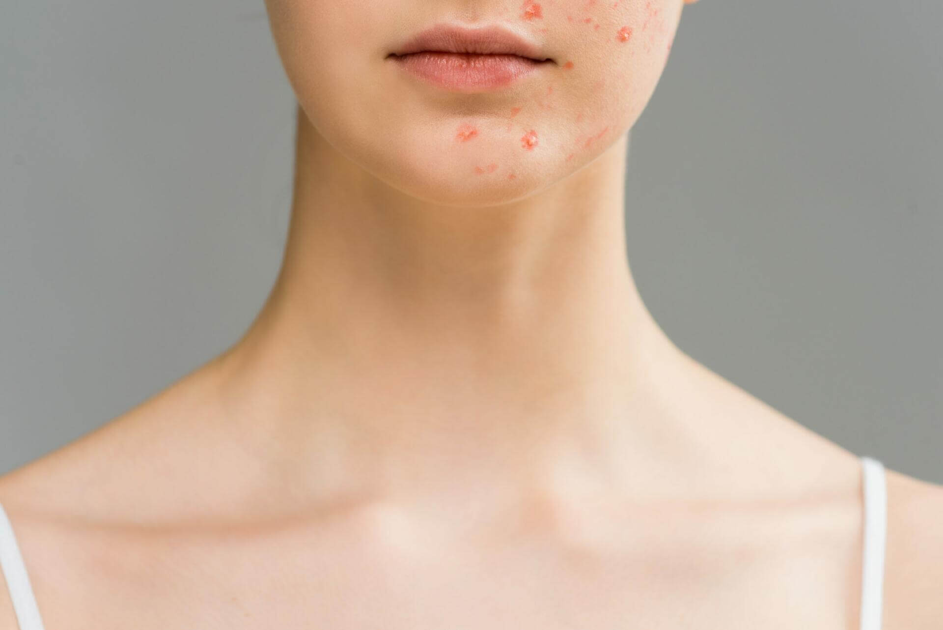 cropped view of young woman with pimples on face isolated on grey