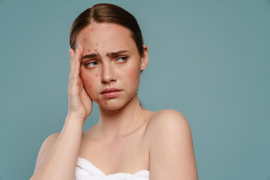 ginger woman with pimples covering her face and looking aside