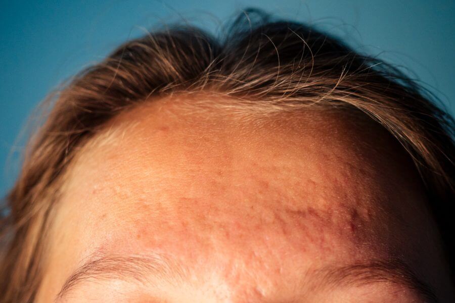 post acne, scars and red festering pimples on the face of a young woman.