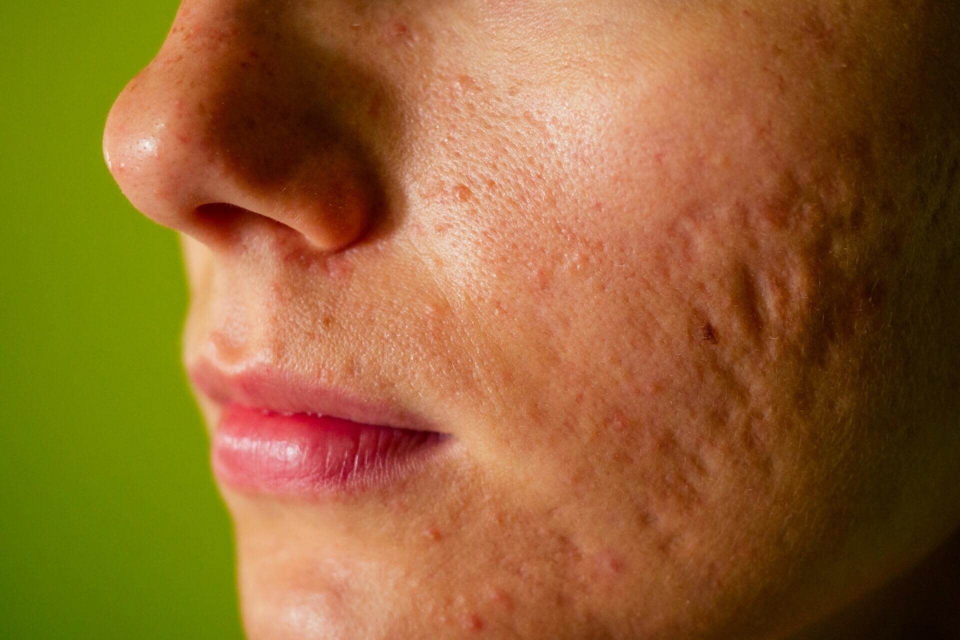 post acne, scars and red festering pimples on the face of a young woman. concept of skin problems and harmonic failure