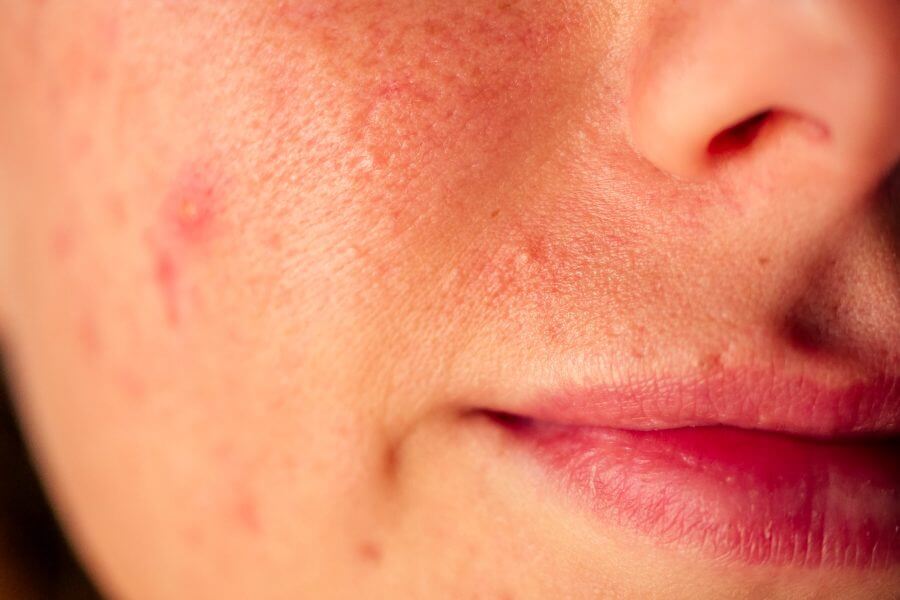 post acne, scars and red festering pimples on the face of a young woman. concept of skin problems and harmonic failure