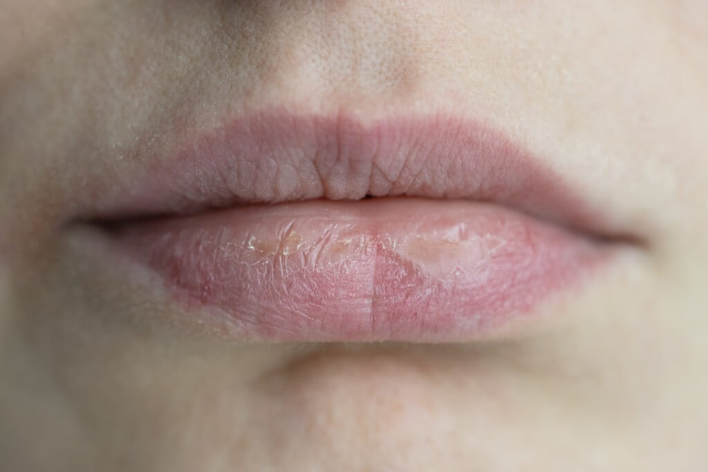 closeup caucasian female face with brittle and dry chapped lips. beauty dermatology concept.