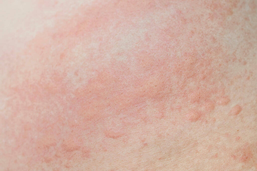 allergic skin rash prickly heat skin red dot close 2023 11 27 05 07 09 utc