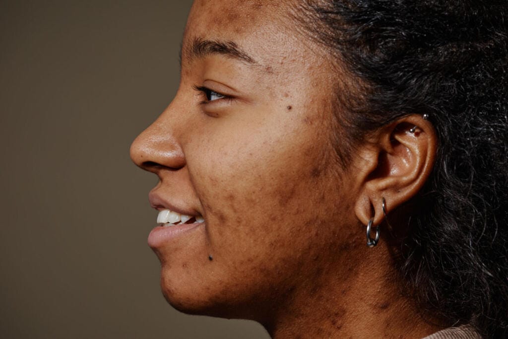 close up smiling black woman with acne scars on fa 2023 11 27 05 12 10 utc