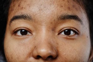 closeup of black young woman with acne scars on fa 2023 11 27 05 15 30 utc