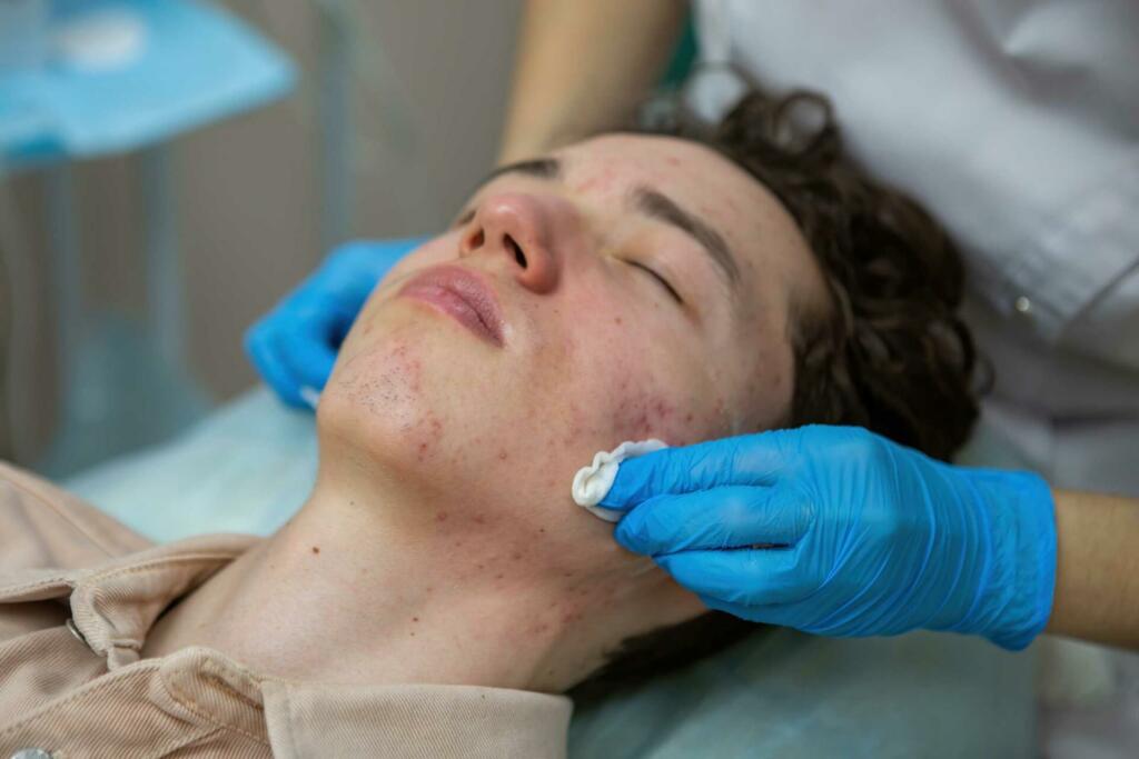 treatment of acne in adolescents facial peeling t 2023 11 27 05 05 37 utc