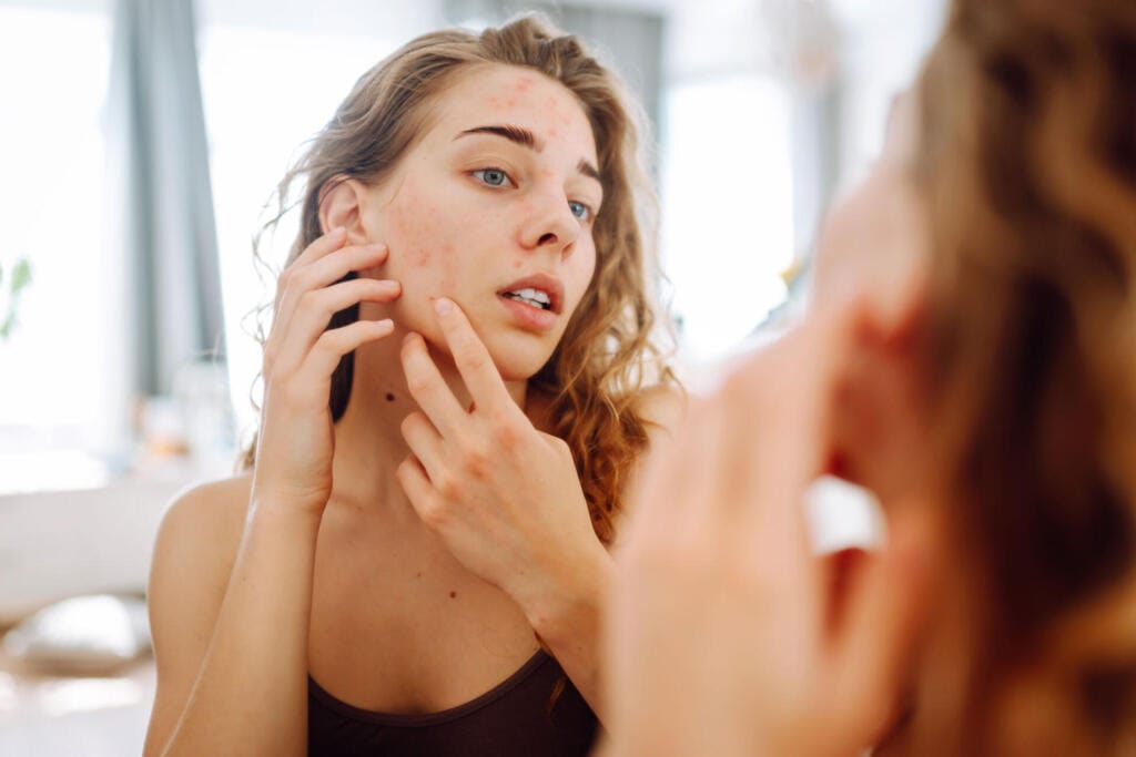 close up of a young woman looking at pimples in th 2024 03 05 16 01 38 utc