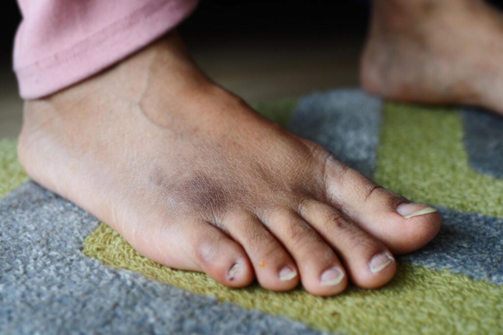 close up of women feet with swelling 2023 11 27 05 19 18 utc