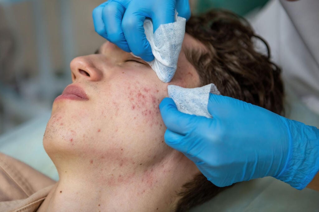 treatment of acne in adolescents facial peeling t 2023 11 27 05 36 59 utc