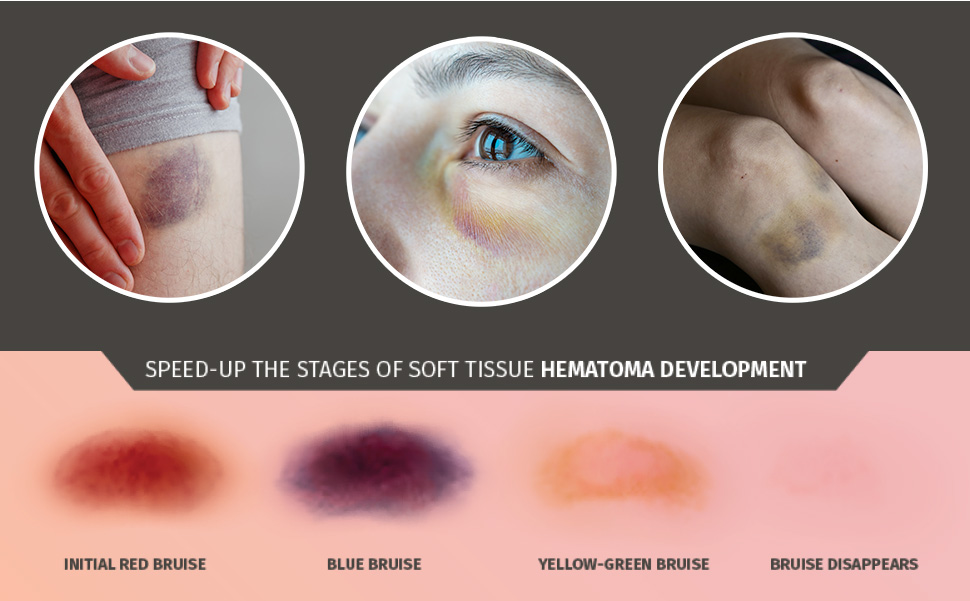 03 speed up the stages of hematoma healing