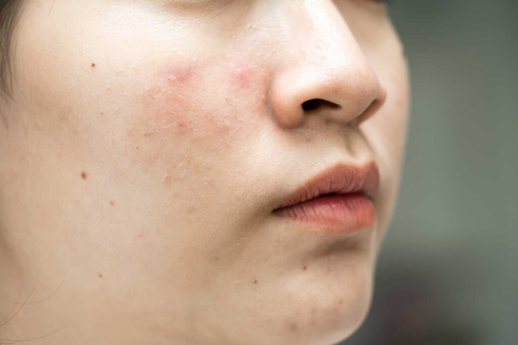 asian young with pimple acne scar on skin facia 2025 02 25 12 08 48 utc